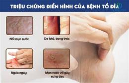 ảnh chụp màn hình bong da chân là bệnh gì