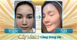 ảnh chụp màn hình cấy meso căng bóng da