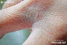 ảnh chụp màn hình da bị bong tróc vảy trắng