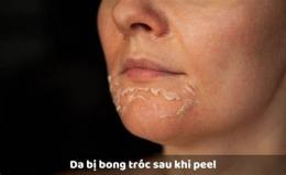 ảnh chụp màn hình da đang bong sau peel nên làm gì