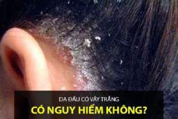 ảnh chụp màn hình da đầu bong tróc từng mảng