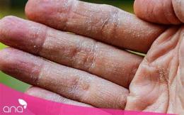 ảnh chụp màn hình da tay bị khô bong tróc phải làm sao