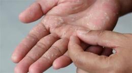ảnh chụp màn hình da tay chân bị khô bong tróc phải làm sao