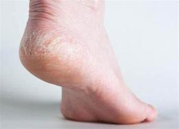 ảnh chụp màn hình gót chân bị bong tróc da