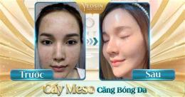 ảnh chụp màn hình meso trắng da căng bóng