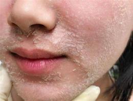 ảnh chụp màn hình peel lightening a có bong da không