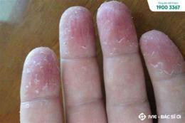 ảnh chụp màn hình tay bị bong tróc da là bị gì