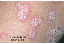 ảnh chụp màn hình viêm da bong vảy