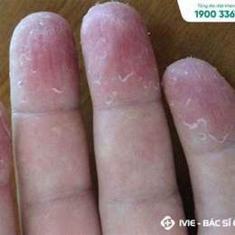 bị bong da ở đầu ngón tay là bệnh gì