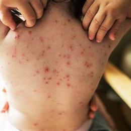 bỏng dạ có lây không