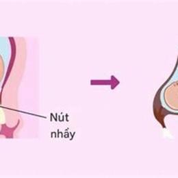 bong nút nhầy bao lâu thì chuyển dạ