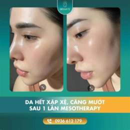 cấy meso căng bóng da