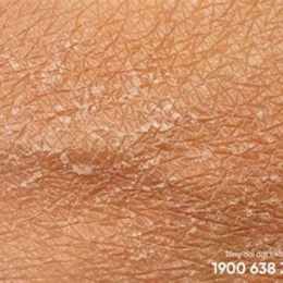 da bị bong tróc do đâu