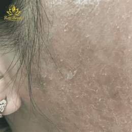 da bị bong tróc ở mặt