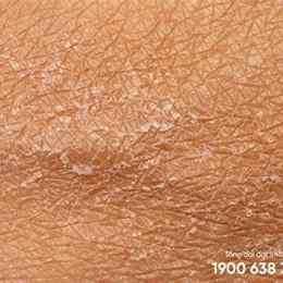 da bị bong tróc vảy trắng