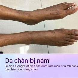 da bị bỏng