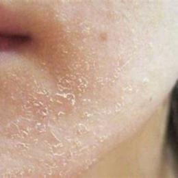 da bị khô bong tróc phải làm sao