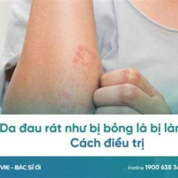 da bị rát như bỏng