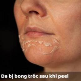 da bong sau peel bị đỏ