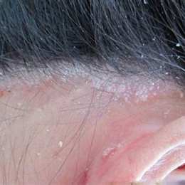 da đầu bị bong tróc từng mảng