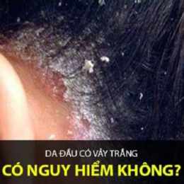 da đầu bong tróc từng mảng