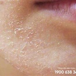 da mặt bị bong tróc vảy trắng có sao không