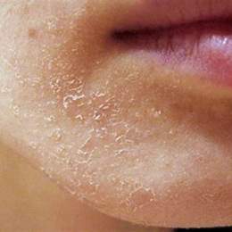 da quanh miệng bị khô bong tróc
