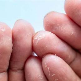 đầu ngón tay bị khô bong da