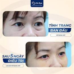 giao diện app cách trị bọng mắt bằng nước đá