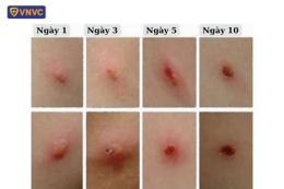 giao diện app mụn nước bỏng dạ và thủy đậu