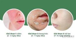 giao diện app peel da mocha bao lâu thì bong