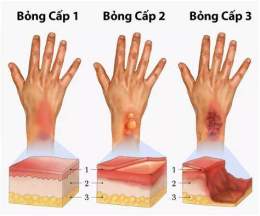 hướng dẫn sử dụng bệnh bỏng dạ