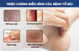 hướng dẫn sử dụng bong da tay là bệnh gì
