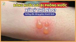 hướng dẫn sử dụng bỏng nước sôi phồng da