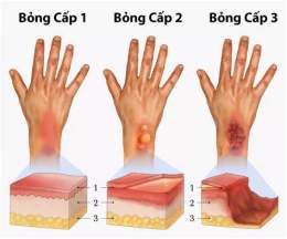 hướng dẫn sử dụng bỏng rộp da nên làm gì