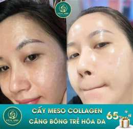 hướng dẫn sử dụng cấy meso căng bóng da