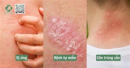 hướng dẫn sử dụng da khô ngứa mẩn đỏ bong tróc