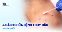 hướng dẫn sử dụng mụn nước bỏng dạ và thủy đậu