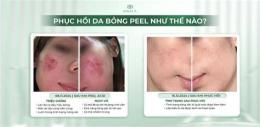 hướng dẫn sử dụng peel da bị bỏng nhẹ