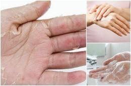hướng dẫn sử dụng tại sao da tay bị khô và bong tróc