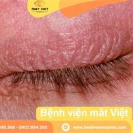 mí mắt bị khô bong da