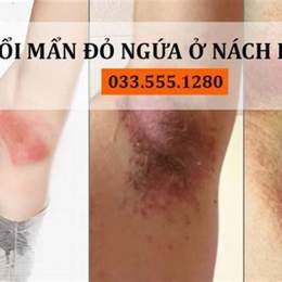 nách bị ngứa và bong da