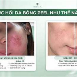 peel da bị bỏng nhẹ