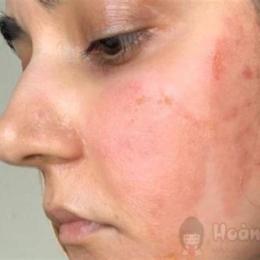 peel da bị bỏng phải làm sao