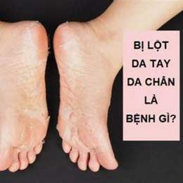 tay chân bị bong da là bệnh gì