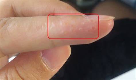 tính năng nổi bật bị bong da ở đầu ngón tay là bệnh gì
