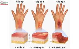 tính năng nổi bật bỏng da bôi gì
