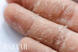 tính năng nổi bật bong da tay chân là thiếu chất gì