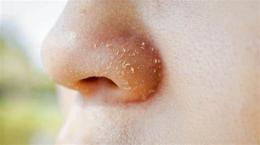 tính năng nổi bật cánh mũi bị khô bong da