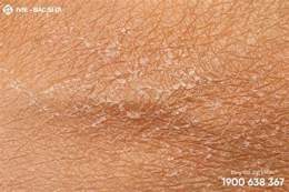 tính năng nổi bật chân bị bong tróc da
